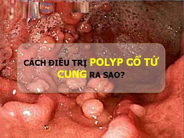 Cách chữa trị bệnh polyp cổ tử cung ở chị em phụ nữ hiệu quả