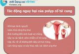Dấu hiệu và tác hại của polyp cổ tử cung ở chị em phụ nữ