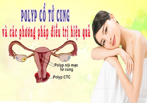 Tổng quan về bệnh polyp cổ tử cung ở chị em phụ nữ