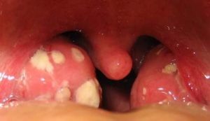 Hình ảnh bệnh lậu ở miệng và tác hại của bệnh gây ra