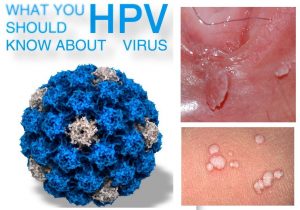 Hình ảnh sùi mào gà do virut HPV