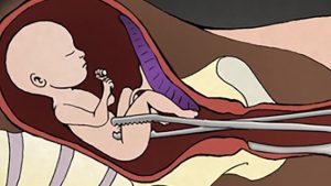 Phá thai bằng phương pháp nong, gắp